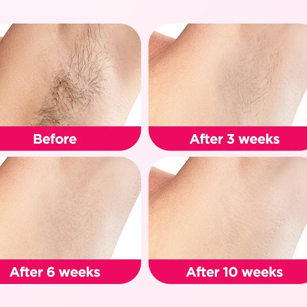 Painless IPL Laser Hair Removal Device